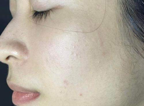 Dịch vụ trị mụn laser