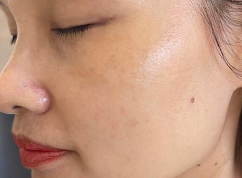 Dịch vụ trị nám