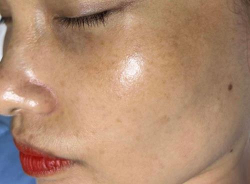 Dịch vụ trị nám