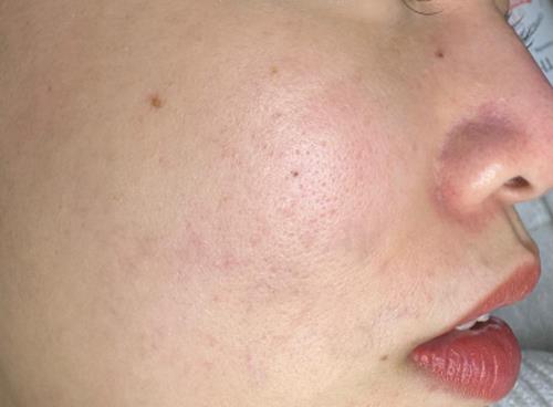 Dịch vụ trị nám