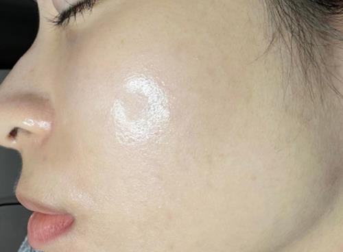 Dịch vụ trị mụn laser