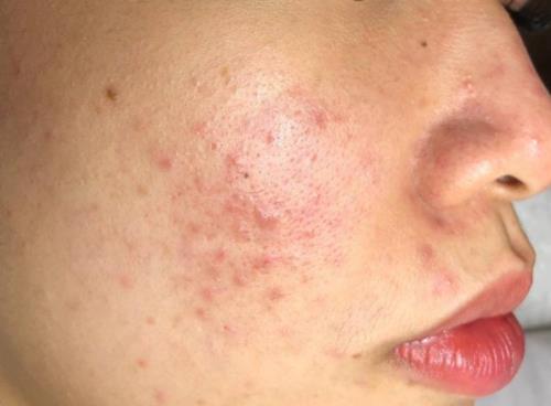 Dịch vụ trị nám